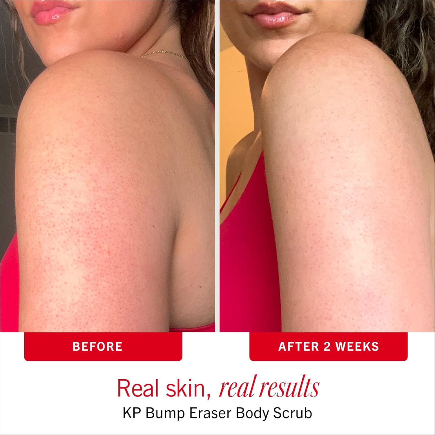 First Aid Beauty KP Bump Eraser Body Scrub with 10% AHA - Dermatologist-Tested Keratosis Pilaris Exfoliator - Support for Rough Bumps, Uneven Skin Texture & Strawberry Skin - Sensitive Skin
