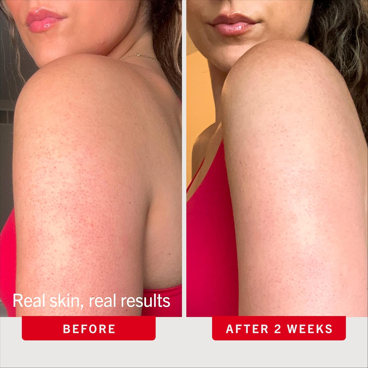 First Aid Beauty KP Bump Eraser Body Scrub with 10% AHA - Dermatologist-Tested Keratosis Pilaris Exfoliator - Support for Rough Bumps, Uneven Skin Texture & Strawberry Skin - Sensitive Skin