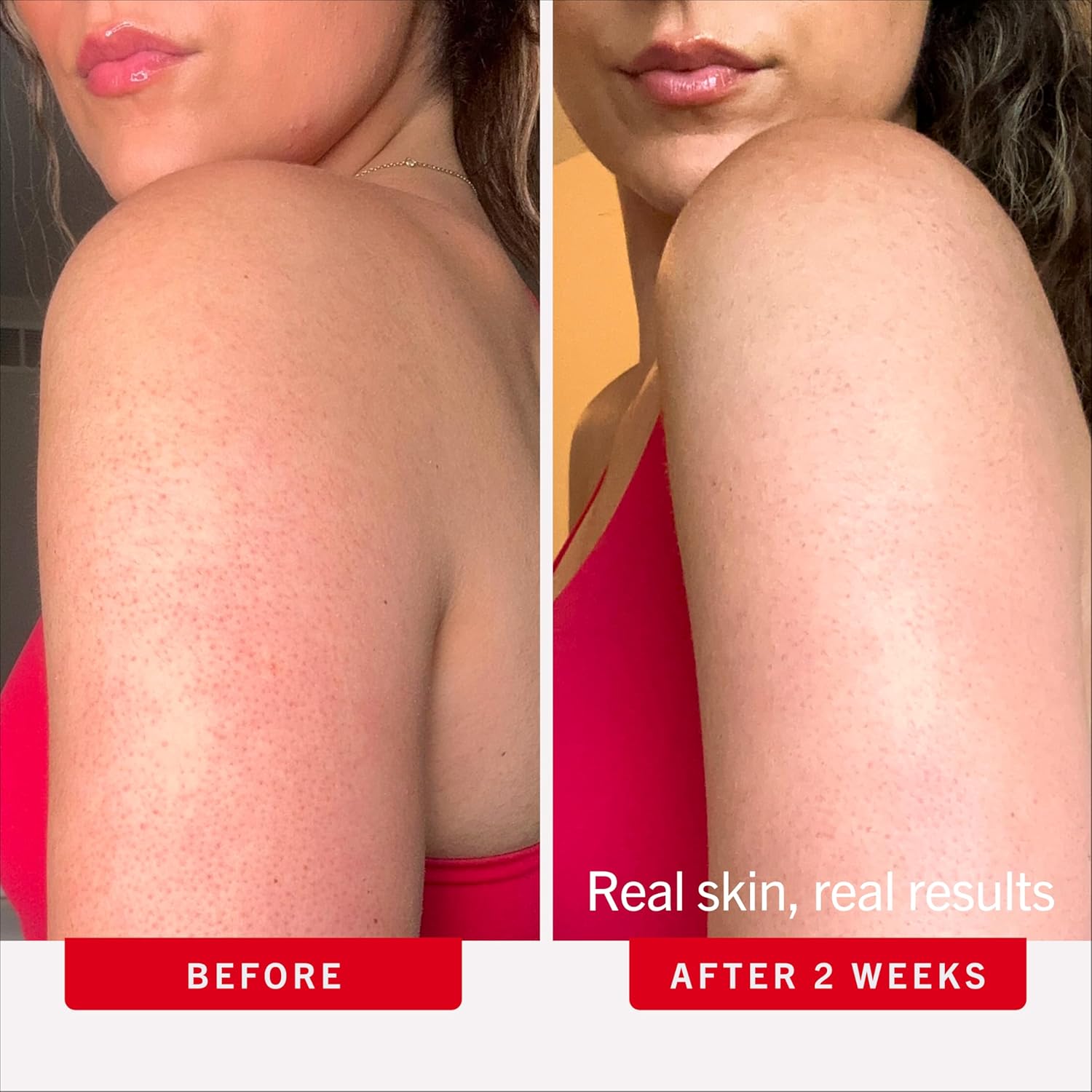 First Aid Beauty KP Bump Eraser Body Scrub with 10% AHA - Dermatologist-Tested Keratosis Pilaris Exfoliator - Support for Rough Bumps, Uneven Skin Texture & Strawberry Skin - Sensitive Skin